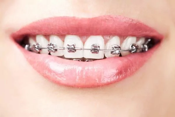 How to Tell If You Need Braces