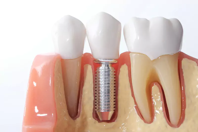 How Much Do Dental Implants Cost